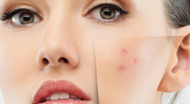 Akne | Sivilce | Tedavisi | Fraksiyonel Lazer | Antiaging